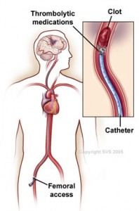 Thrombolytic Therapy